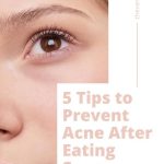 5 tips to prevent acne after eating sugar thevenusface