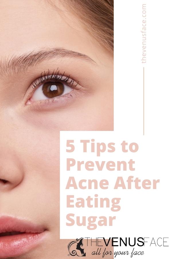 5 tips to prevent acne after eating sugar thevenusface