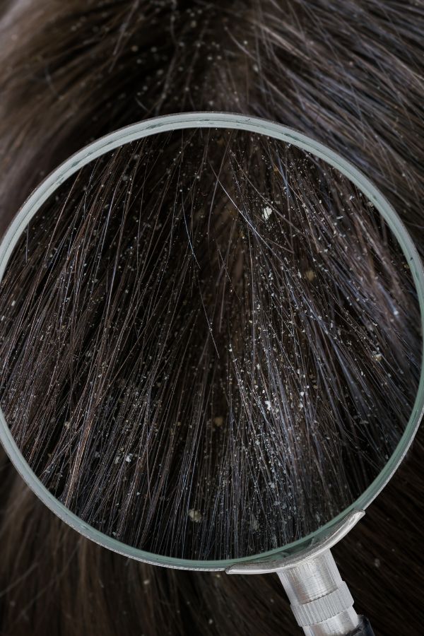 How to Get Rid of Dandruff on Black Hair thevenusface